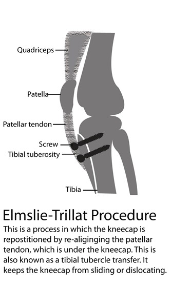 Illustrations: Elmsie-Trillat Procedure