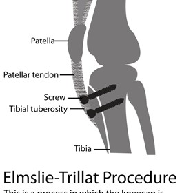 Illustrations: Elmsie-Trillat Procedure